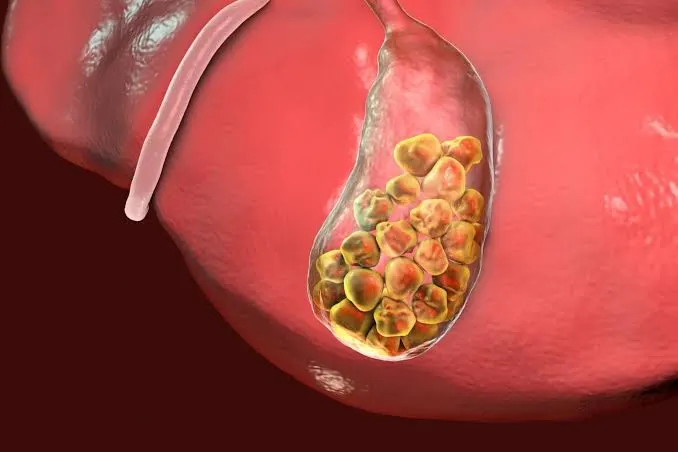 Piedras en la vesícula: ¿cuándo el dolor después de comer puede indicar que necesitas cirugía?